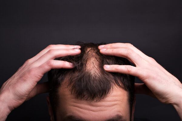 Saç dökülmesi nasıl önlenir? İşte püf noktaları