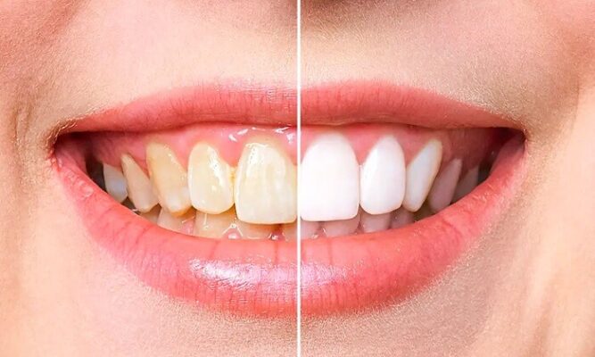 Dişlerinizi Nasıl Beyazlatırsınız? (İşte Dişlerinizi Beyazlatmak İçin Dikkat Edilmesi Gereken 4 Madde)