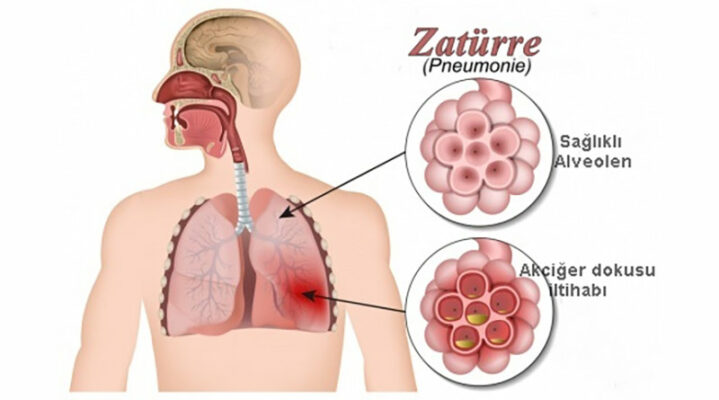 Zatürre (Akciğer İltihabı) Evde Doğal Nasıl Tedavi edilir? 2