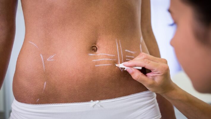 Karın Germe Ameliyatı (Abdominoplasty) Nedir?